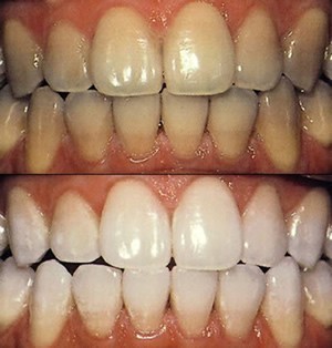 blanqueamiento dental blanqueamiento dental